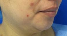 Chin Liposuction Before & After Patient #8332