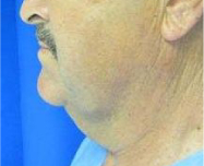 Neck Lift Before & After Patient #10039