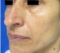 Rhinoplasty Before & After Patient #10313