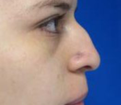 Rhinoplasty Before & After Patient #10306