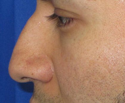 Rhinoplasty Before & After Patient #10293