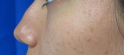 Rhinoplasty Before & After Patient #10155