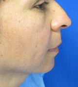 Rhinoplasty Before & After Patient #10142