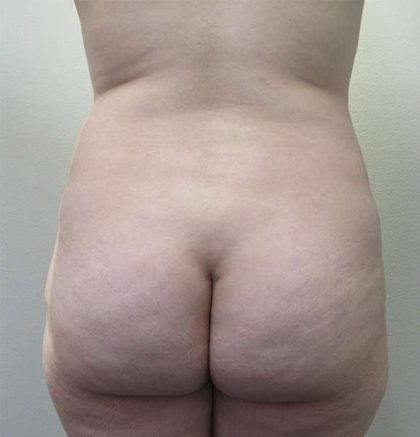 Brazilian Butt Lift Before & After Patient #6248