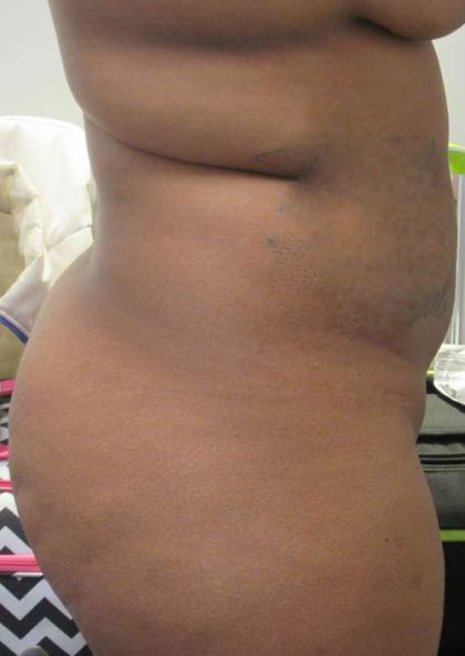 Brazilian Butt Lift Before & After Patient #6259