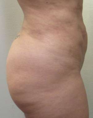 Abdomen Before & After Patient #5880