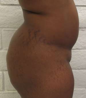 Brazilian Butt Lift Before & After Patient #6312
