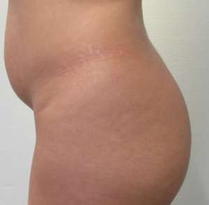Brazilian Butt Lift Before & After Patient #6342