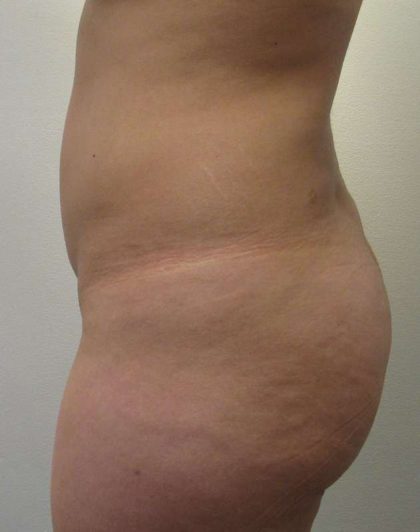 Brazilian Butt Lift Before & After Patient #6358