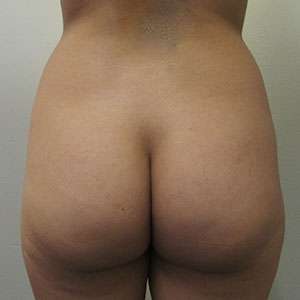 Brazilian Butt Lift Before & After Patient #6369