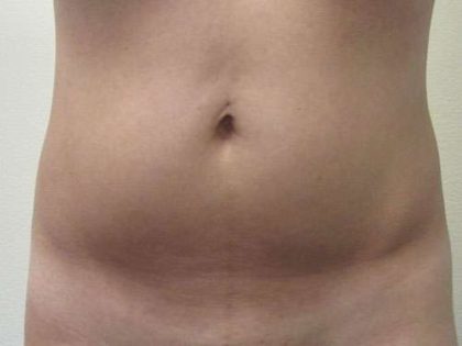 Brazilian Butt Lift Before & After Patient #6378
