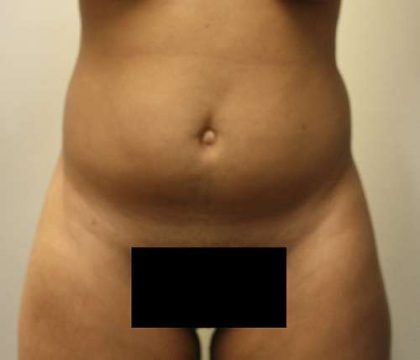 Brazilian Butt Lift Before & After Patient #6390