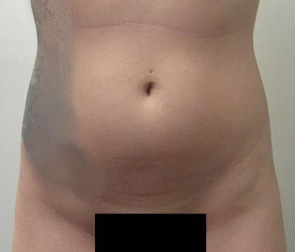 Brazilian Butt Lift Before & After Patient #6395
