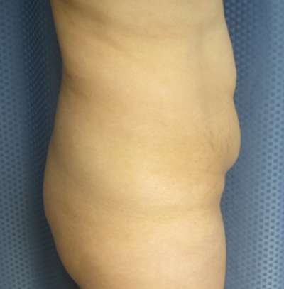 Brazilian Butt Lift Before & After Patient #6408