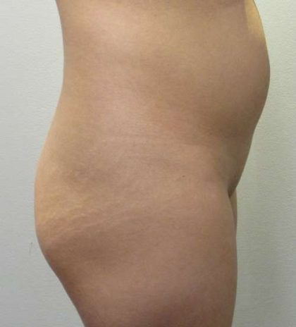 Brazilian Butt Lift Before & After Patient #6443