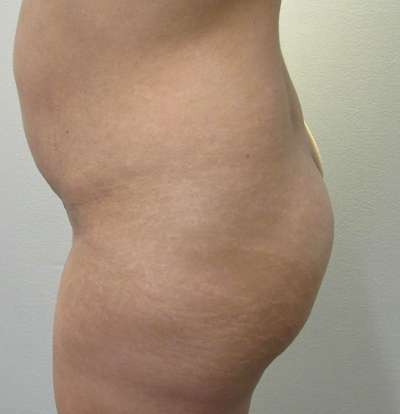 Brazilian Butt Lift Before & After Patient #6455
