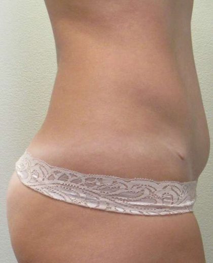 Abdomen Before & After Patient #5907