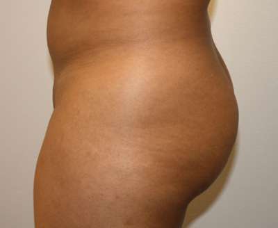 Brazilian Butt Lift Before & After Patient #6482