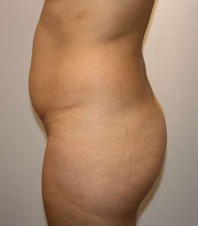 Brazilian Butt Lift Before & After Patient #6498