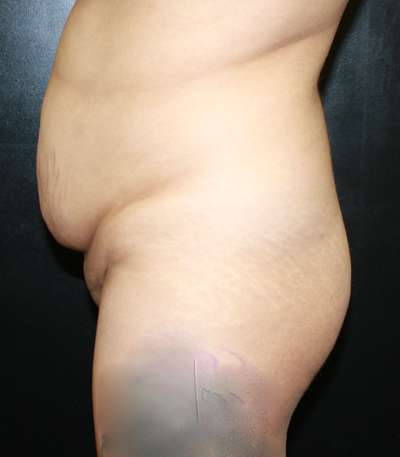 Brazilian Butt Lift Before & After Patient #6503