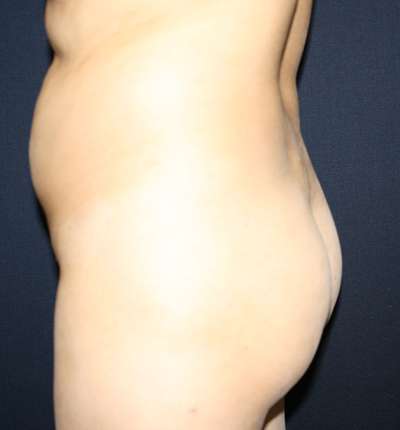 Brazilian Butt Lift Before & After Patient #6524