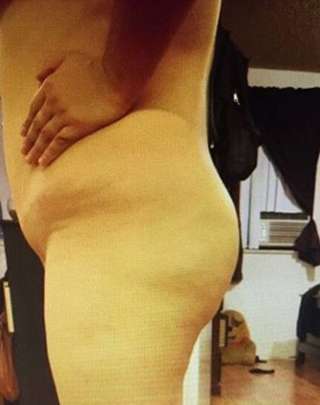 Brazilian Butt Lift Before & After Patient #6532