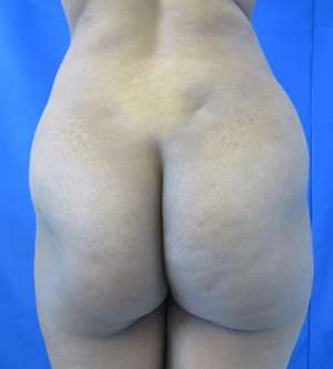 Brazilian Butt Lift Before & After Patient #6548