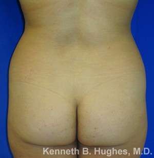 Brazilian Butt Lift Before & After Patient #6557