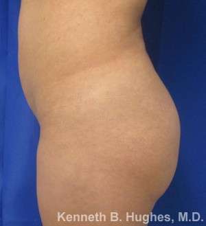 Brazilian Butt Lift Before & After Patient #6567