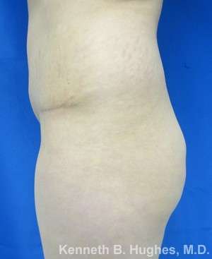 Brazilian Butt Lift Before & After Patient #6575