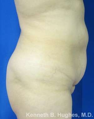 Brazilian Butt Lift Before & After Patient #6582