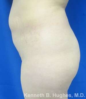 Brazilian Butt Lift Before & After Patient #6596