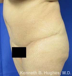 Brazilian Butt Lift Before & After Patient #6616