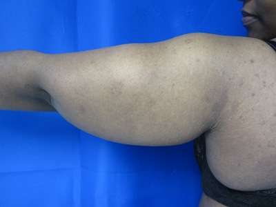 Arm Lift Before & After Patient #5923
