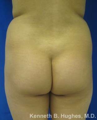 Brazilian Butt Lift Before & After Patient #6637