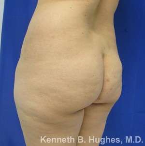 Brazilian Butt Lift Before & After Patient #6673