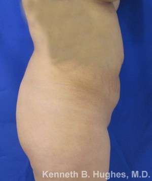 Brazilian Butt Lift Before & After Patient #6691