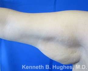 Arm Lift Before & After Patient #5932