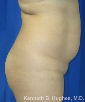 Brazilian Butt Lift Before & After Patient #6702