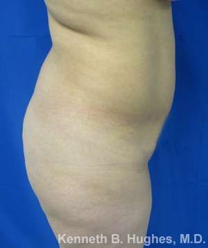 Brazilian Butt Lift Before & After Patient #6733