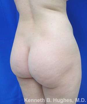 Brazilian Butt Lift Before & After Patient #6738