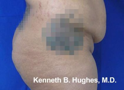 Brazilian Butt Lift Before & After Patient #6749