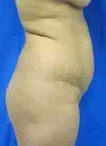 Brazilian Butt Lift Before & After Patient #6760