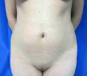 Brazilian Butt Lift Before & After Patient #6804