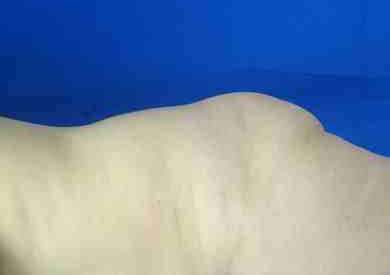 Brazilian Butt Lift Before & After Patient #6809