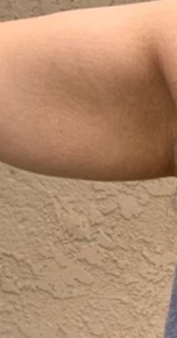 Bodytite Before & After Patient #6164