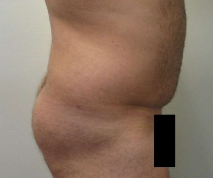 Brazilian Butt Lift Before & After Patient #6223
