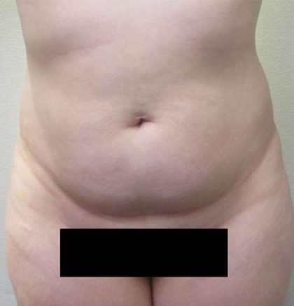 Brazilian Butt Lift Before & After Patient #6248