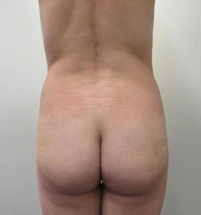 Brazilian Butt Lift Before & After Patient #6378
