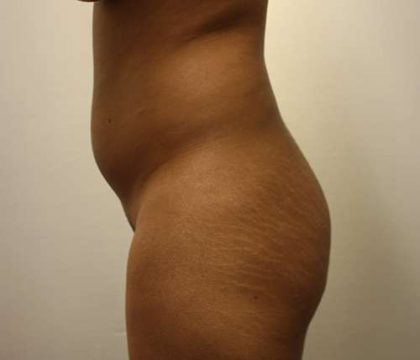 Brazilian Butt Lift Before & After Patient #6390